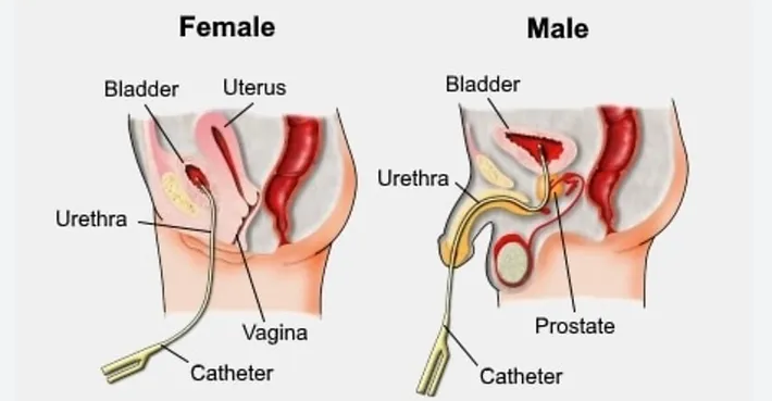 Urinary Catheterization Blog